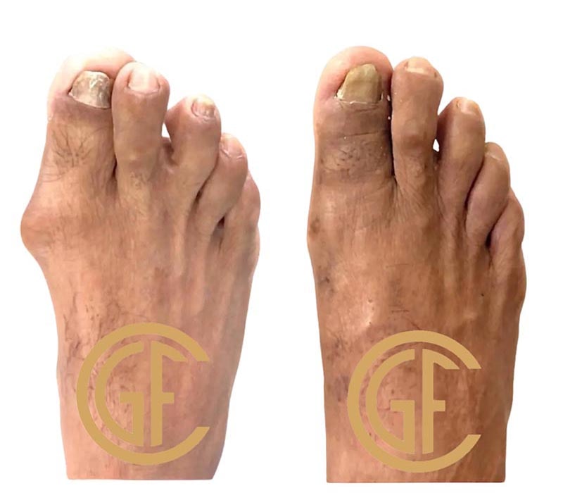 Minimally Invasive Bunion Surgery Before & After Image