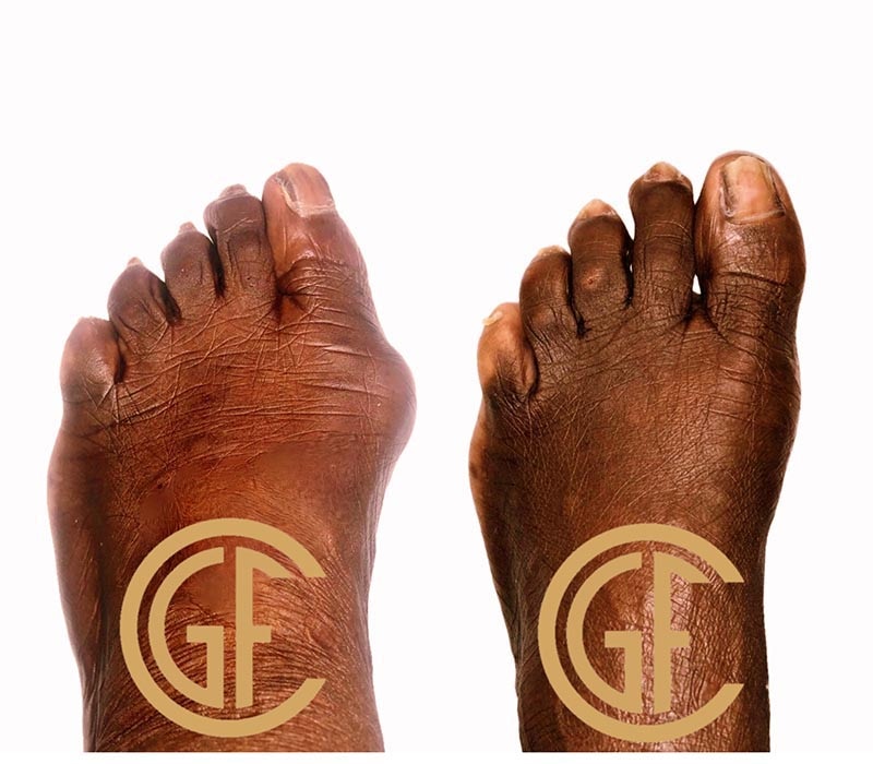 Minimally Invasive Bunion Surgery Before & After Image
