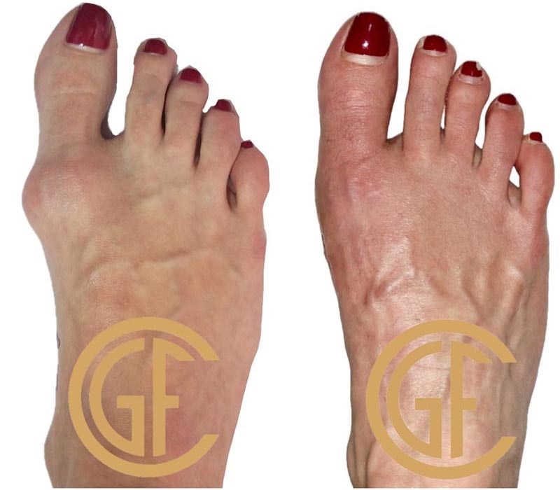 Minimally Invasive Bunion Surgery Before & After Image