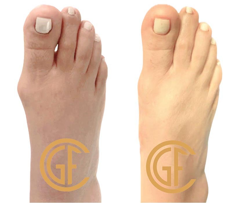 Minimally Invasive Bunion Surgery Before & After Image