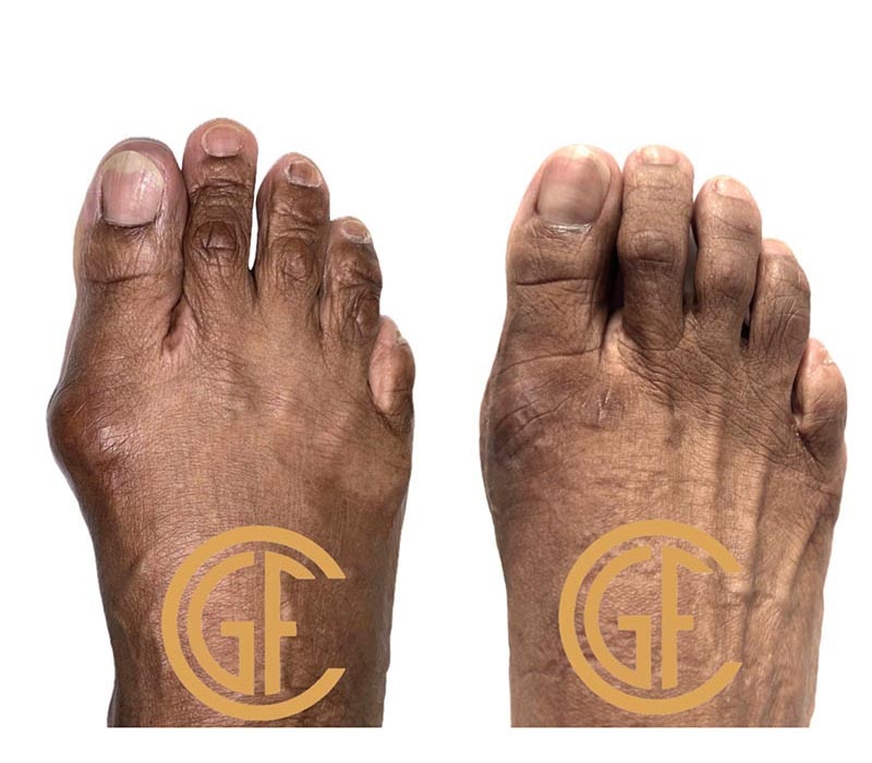 Minimally Invasive Bunion Surgery Before & After Image