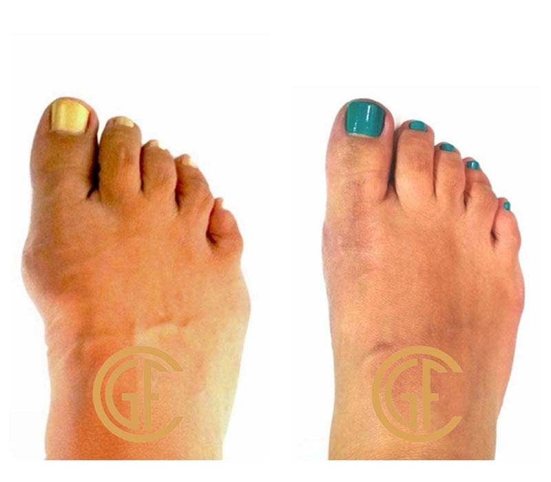 Minimally Invasive Bunion Surgery Before & After Image