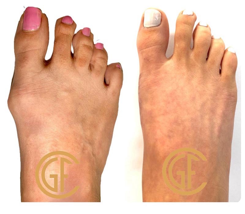 Minimally Invasive Bunion Surgery Before & After Image