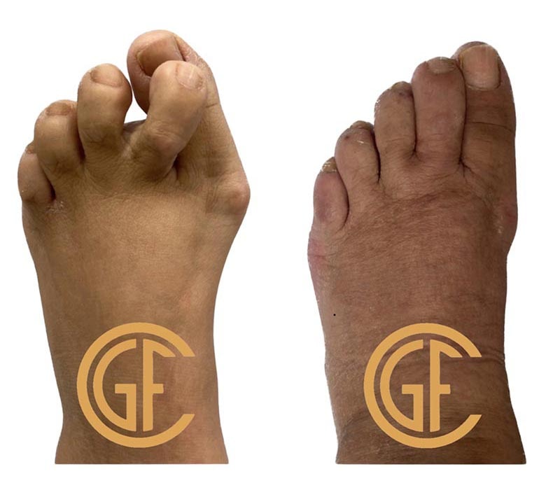 Minimally Invasive Bunion Surgery Before & After Image