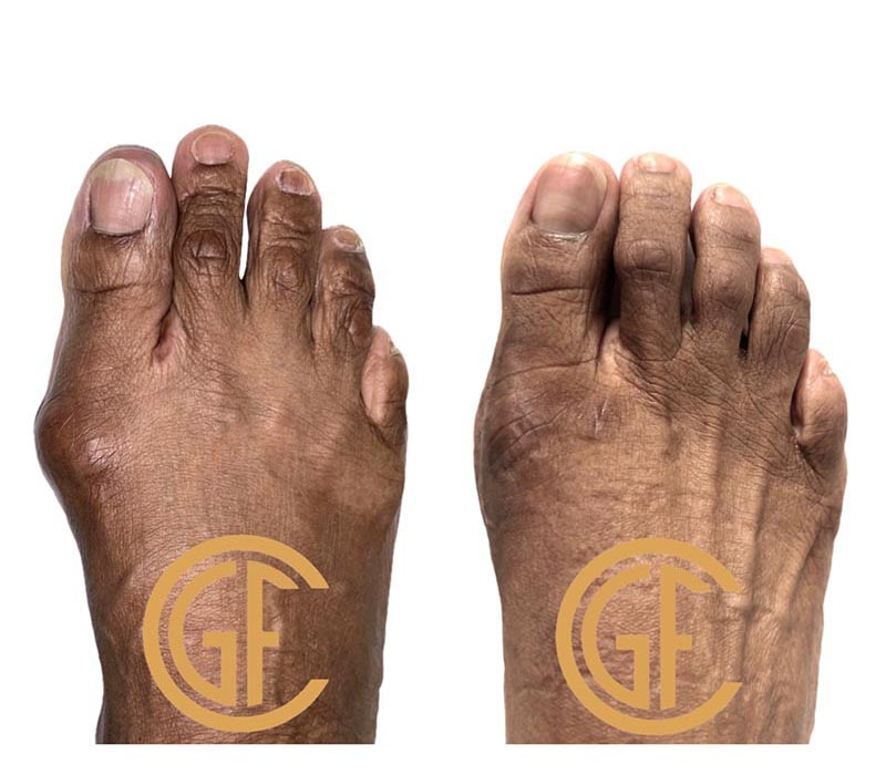 Minimally Invasive Bunion Surgery Before & After Image