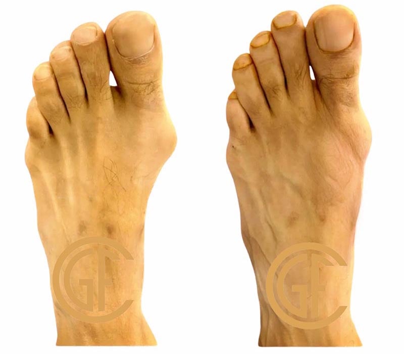 Minimally Invasive Bunion Surgery Before & After Image