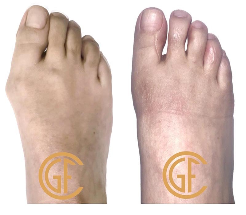 Minimally Invasive Bunion Surgery Before & After Image