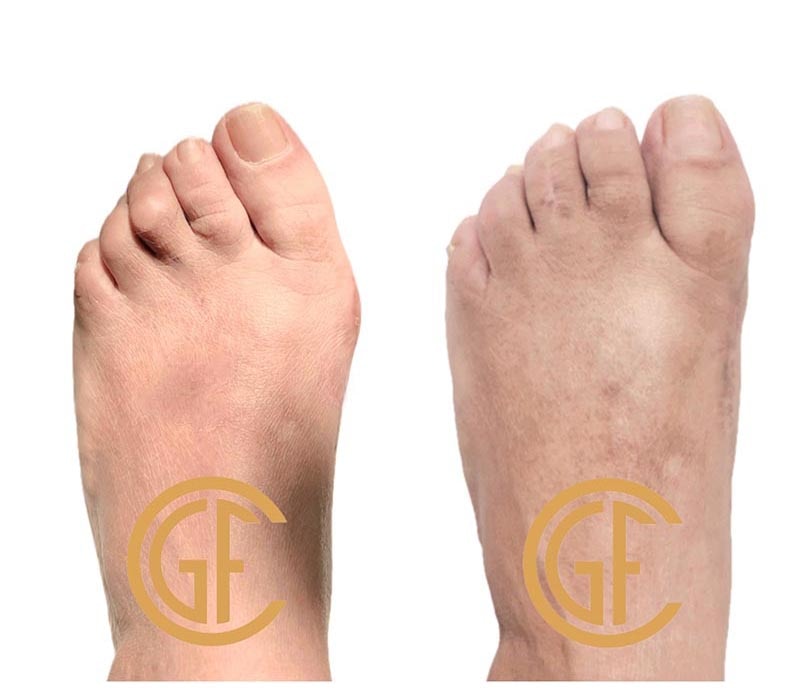 Minimally Invasive Bunion Surgery Before & After Image