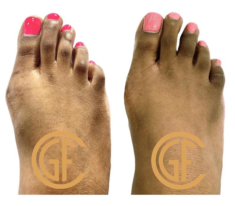 Minimally Invasive Bunion Surgery Before & After Image