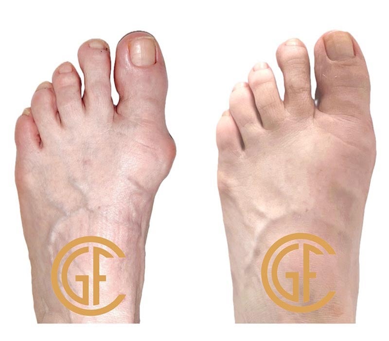 Minimally Invasive Bunion Surgery Before & After Image