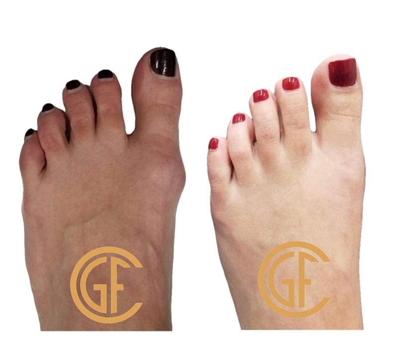 Minimally Invasive Bunion Surgery Before & After Image