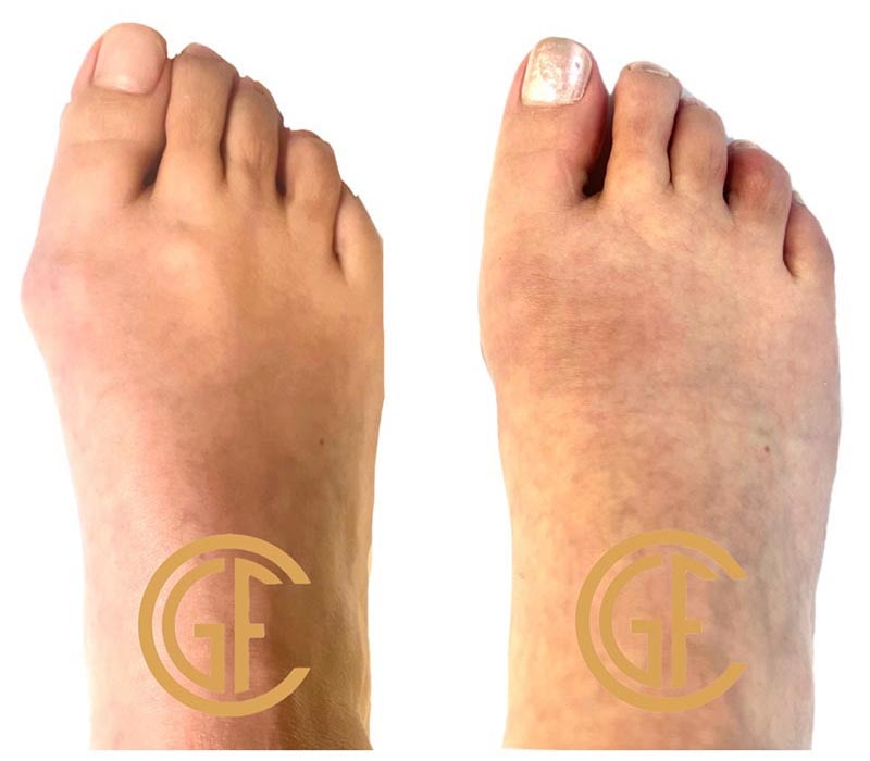 Minimally Invasive Bunion Surgery Before & After Image