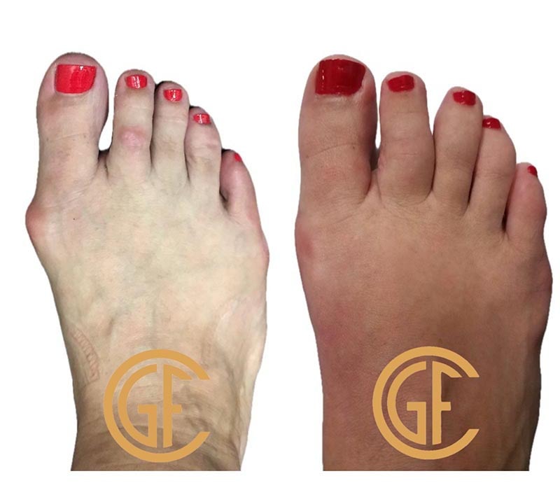 Minimally Invasive Bunion Surgery Before & After Image