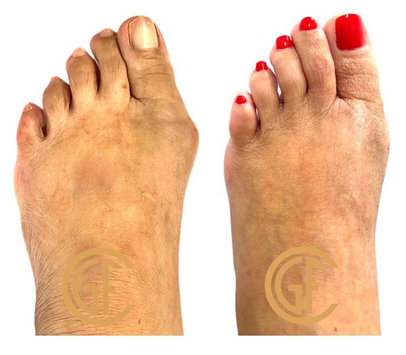 Minimally Invasive Bunion Surgery Before & After Image