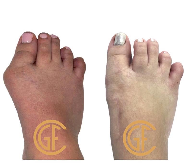 Minimally Invasive Bunion Surgery Before & After Image