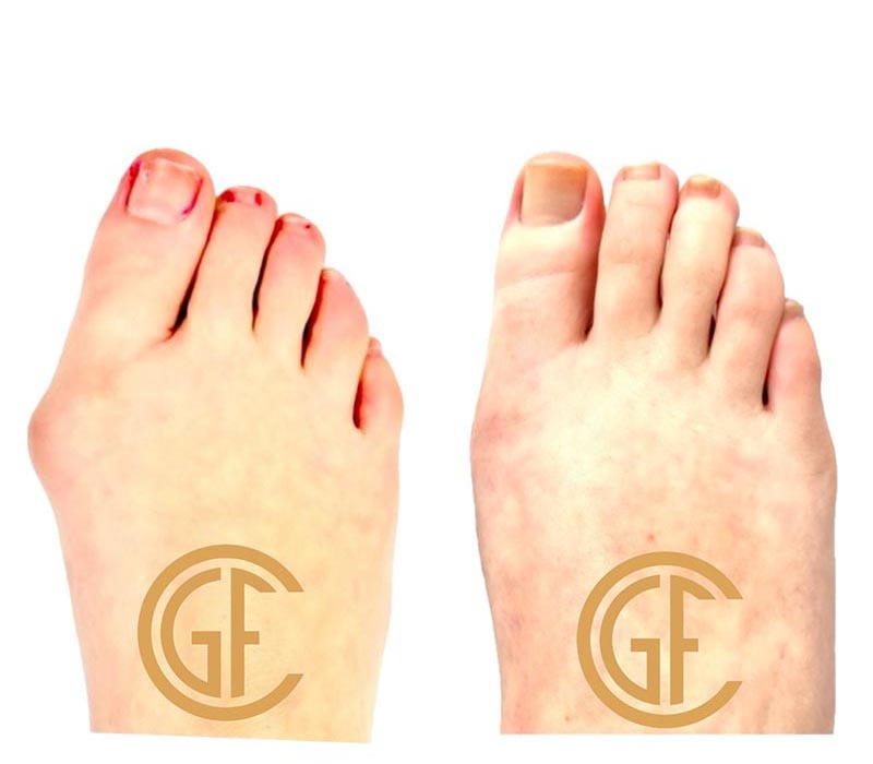 Minimally Invasive Bunion Surgery Before & After Image