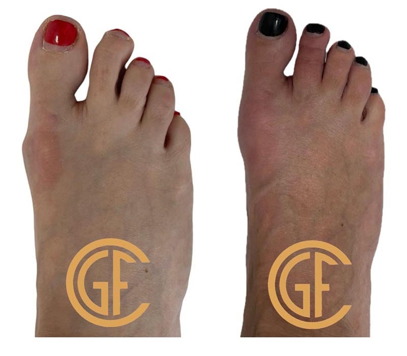Minimally Invasive Bunion Surgery Before & After Image