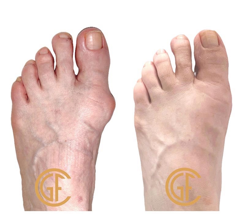 Minimally Invasive Bunion Surgery Before & After Image