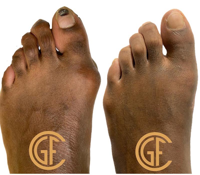 Minimally Invasive Bunion Surgery Before & After Image