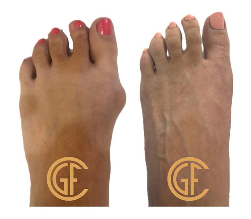 Minimally Invasive Bunion Surgery Before & After Image