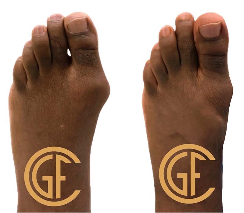 Minimally Invasive Bunion Surgery Before & After Image