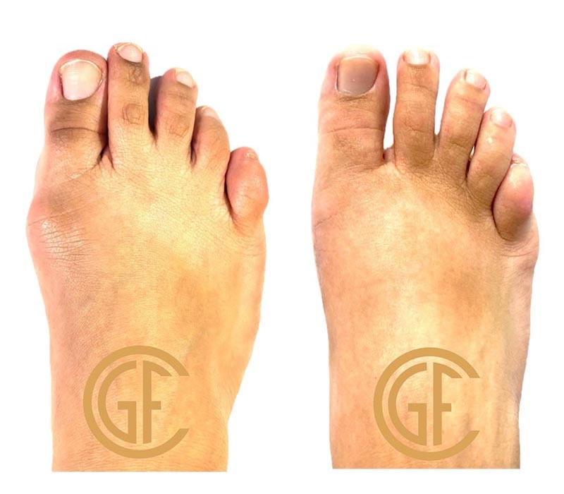 Minimally Invasive Bunion Surgery Before & After Image