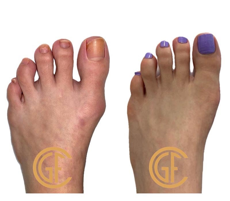 Minimally Invasive Bunion Surgery Before & After Image