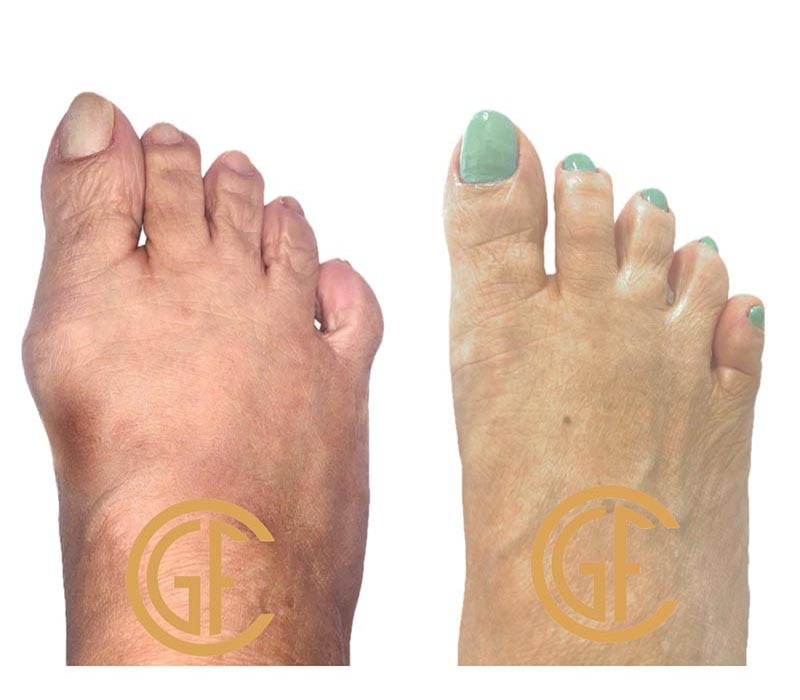 Minimally Invasive Bunion Surgery Before & After Image