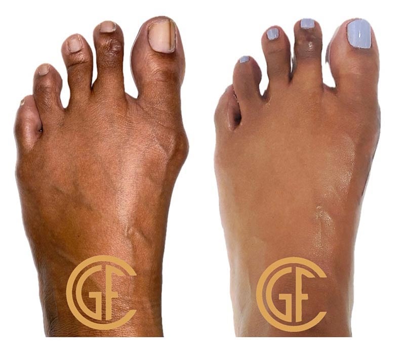 Minimally Invasive Bunion Surgery Before & After Image