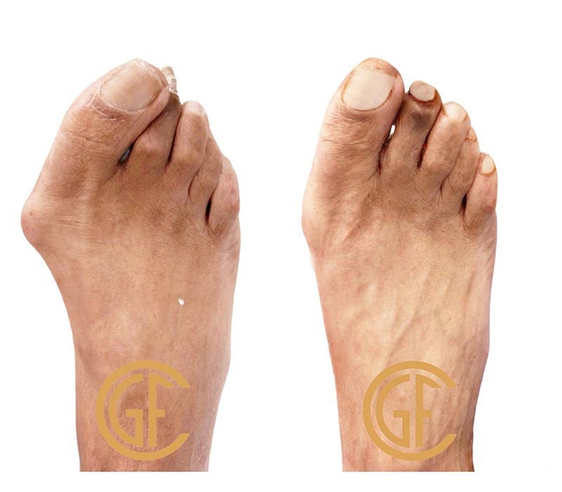 Minimally Invasive Bunion Surgery Before & After Image