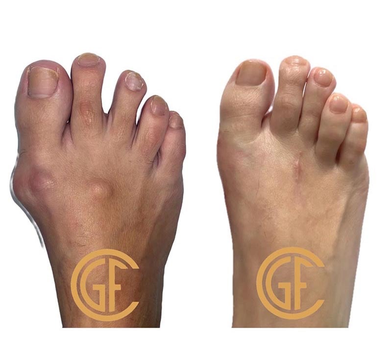 Minimally Invasive Bunion Surgery Before & After Image