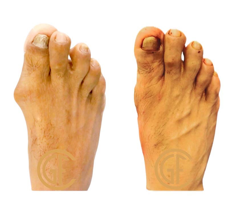 Minimally Invasive Bunion Surgery Before & After Image