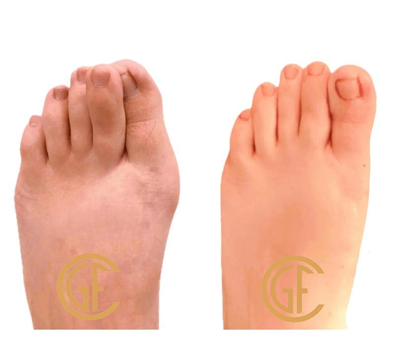 Minimally Invasive Bunion Surgery Before & After Image