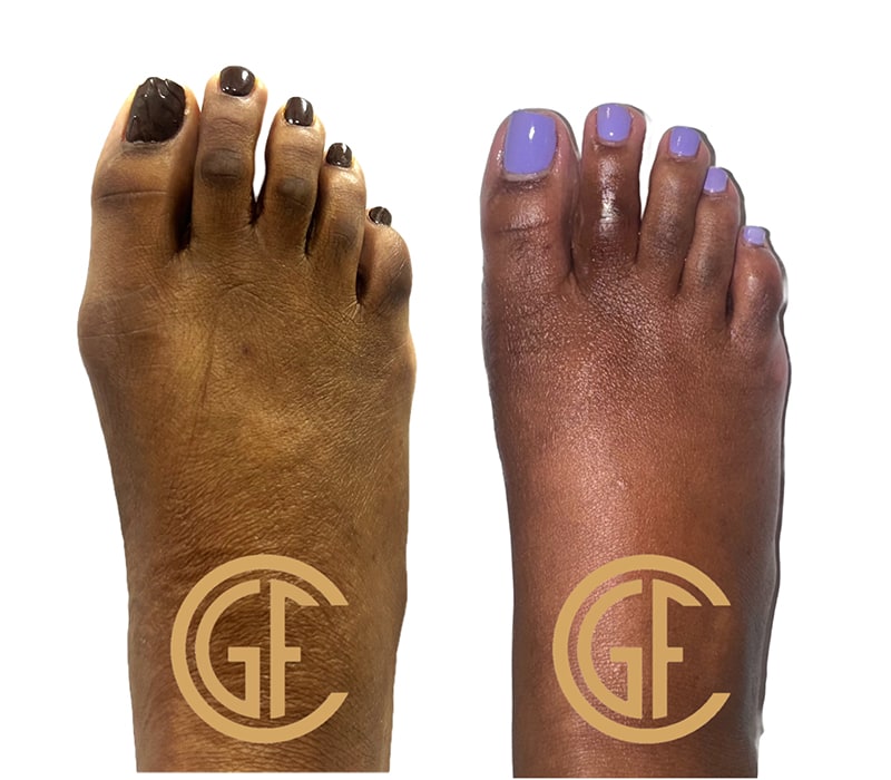 Minimally Invasive Bunion Surgery Before & After Image