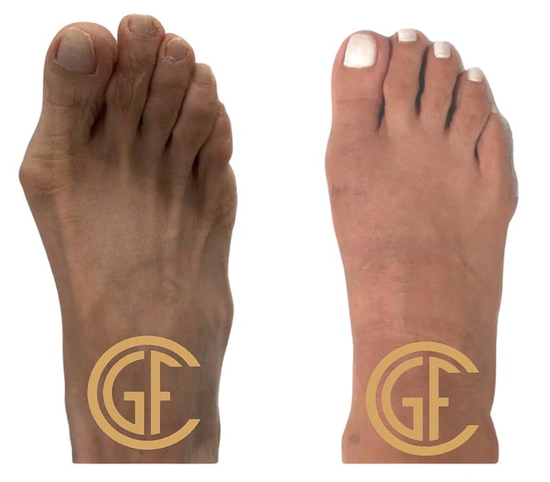 Minimally Invasive Bunion Surgery Before & After Image