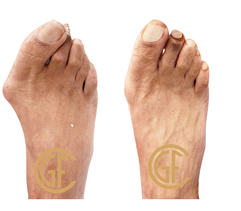 Foot Reconstruction Before & After Image