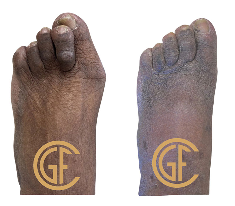 Foot Reconstruction Before & After Image