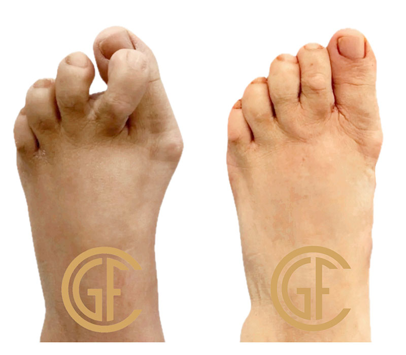 Foot Reconstruction Before & After Image