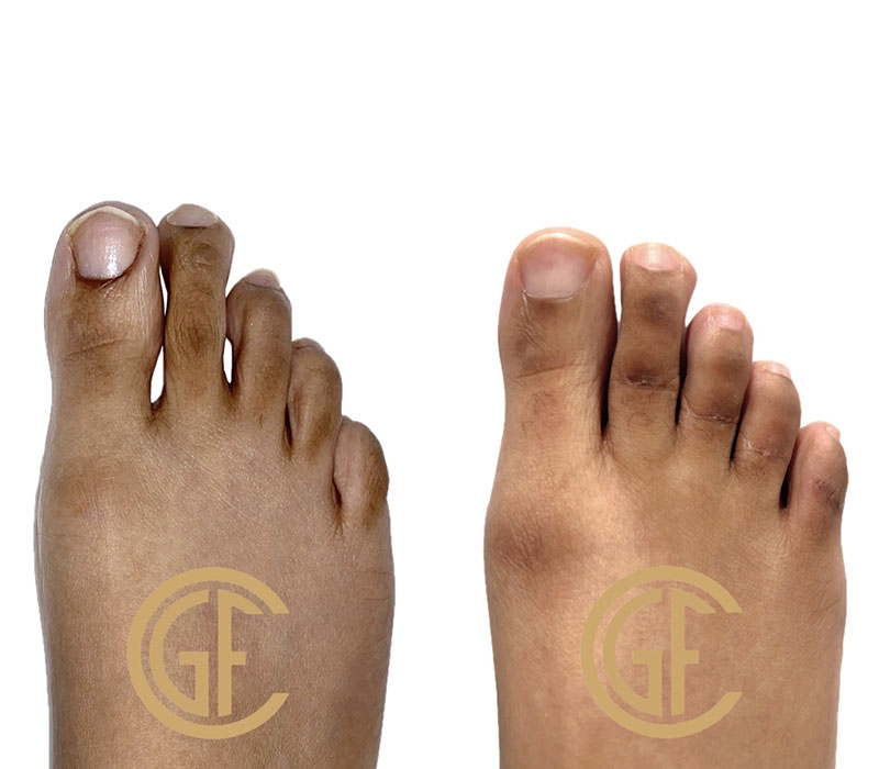 Hammer Toe Surgery Before & After Image