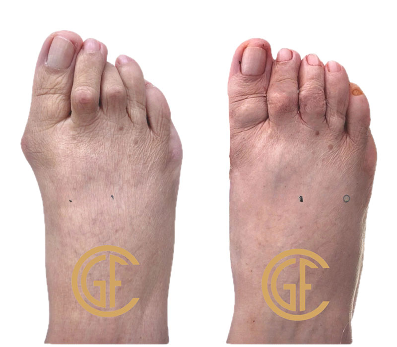 Hammer Toe Surgery Before & After Image