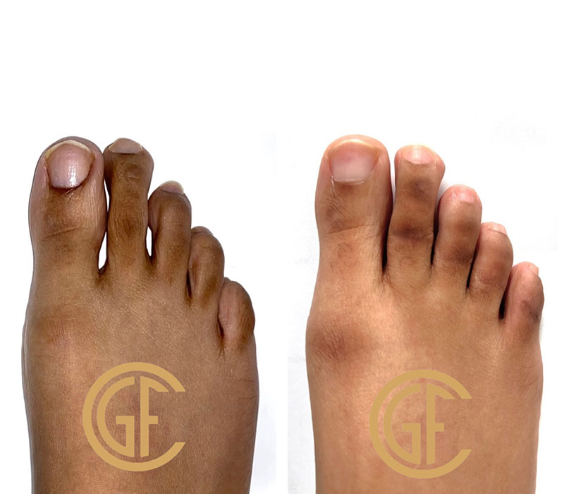 Hammer Toe Surgery Before & After Image