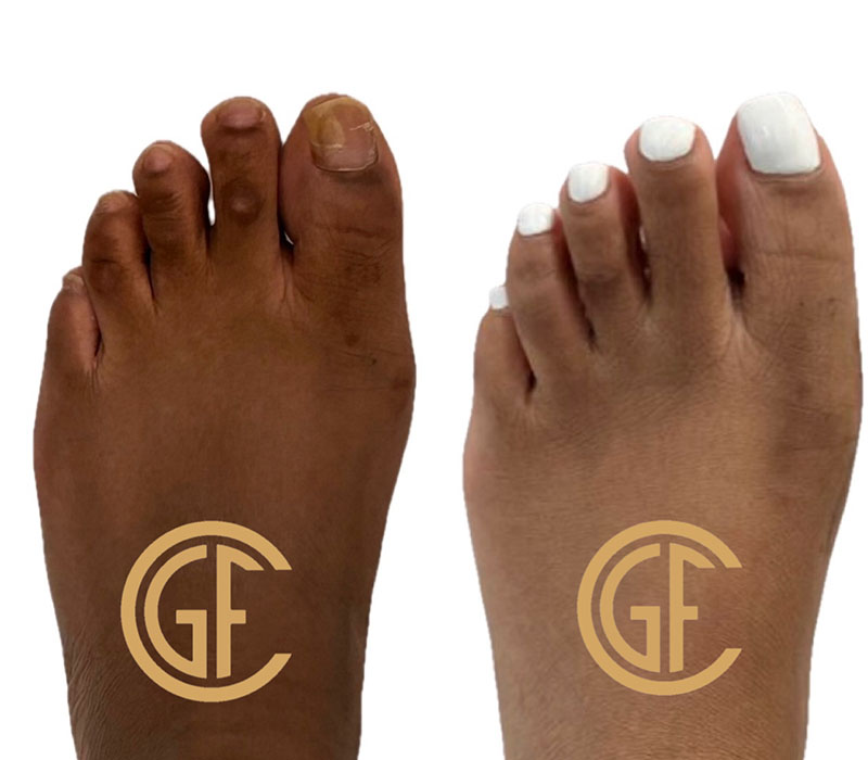 Hammer Toe Surgery Before & After Image