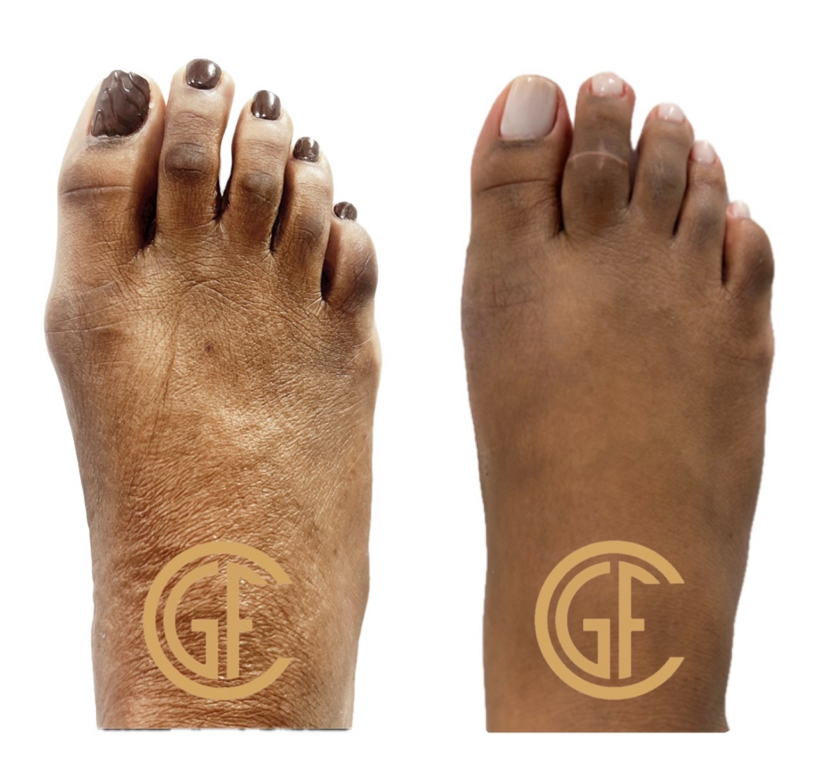 Hammer Toe Surgery Before & After Image
