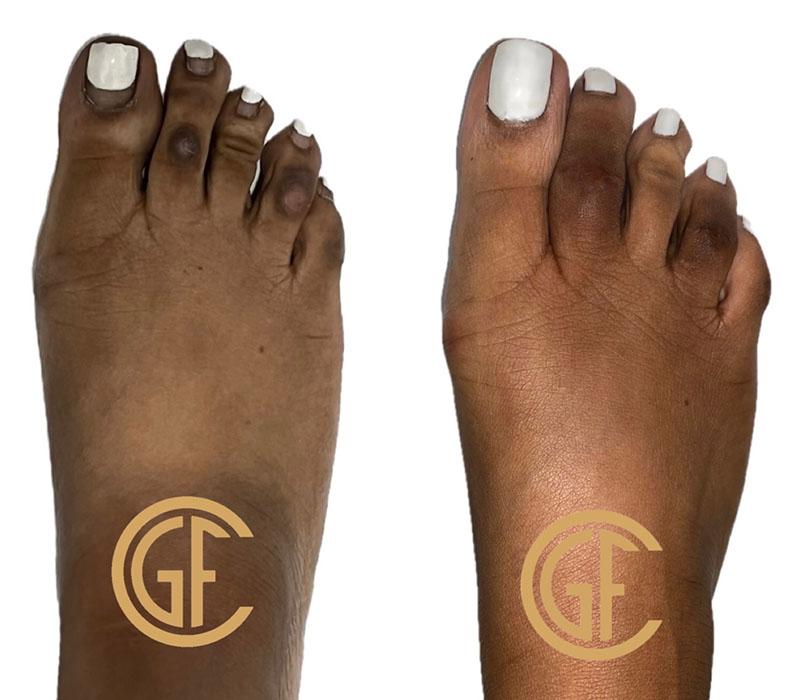 Hammer Toe Surgery Before & After Image