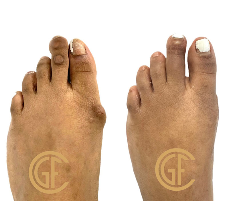 Hammer Toe Surgery Before & After Image