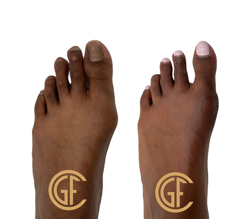 Hammer Toe Surgery Before & After Image