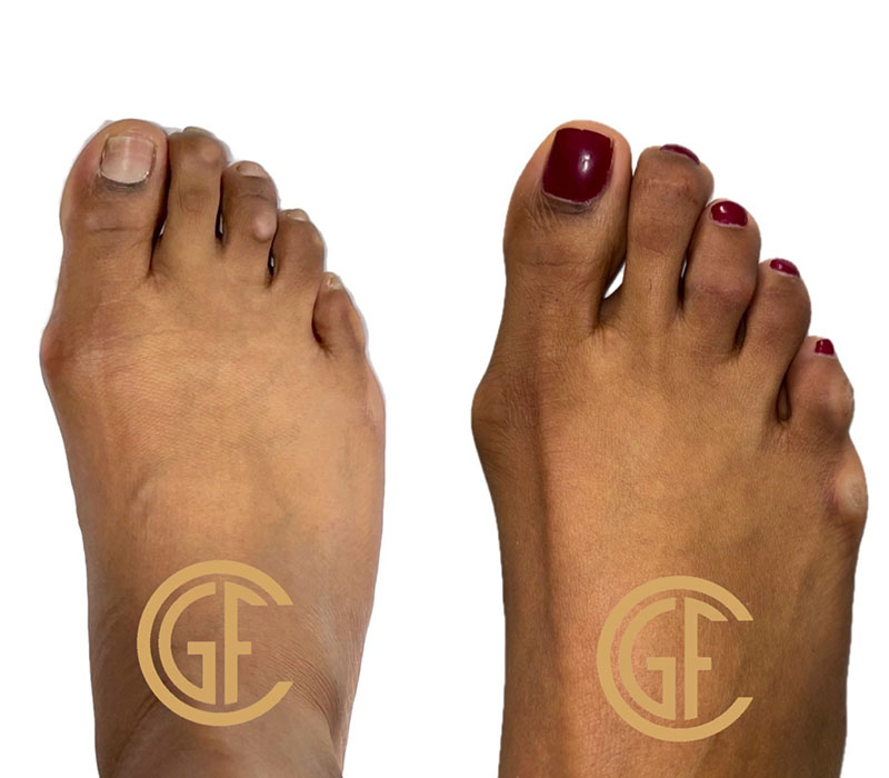 Hammer Toe Surgery Before & After Image