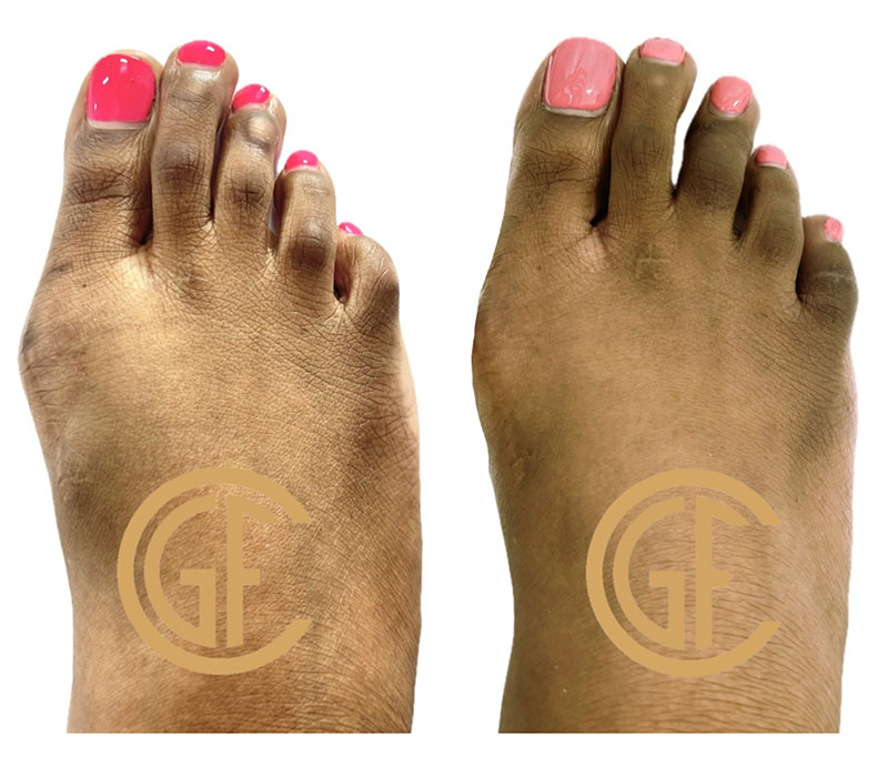 Hammer Toe Surgery Before & After Image