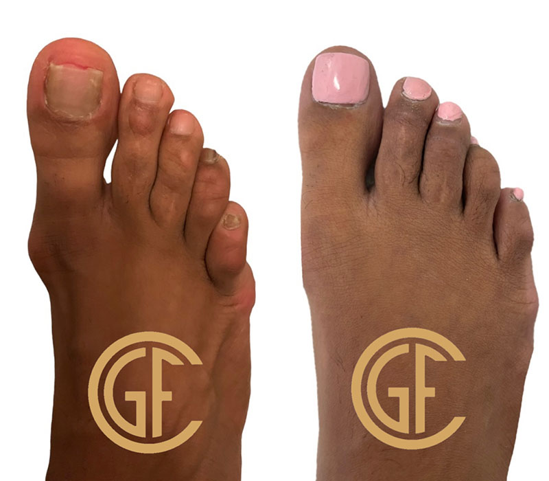 Hammer Toe Surgery Before & After Image